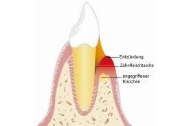 Parodontose