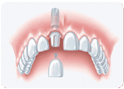 Implantat Zähne