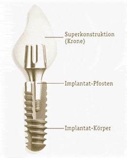 Konstruktion Implantat